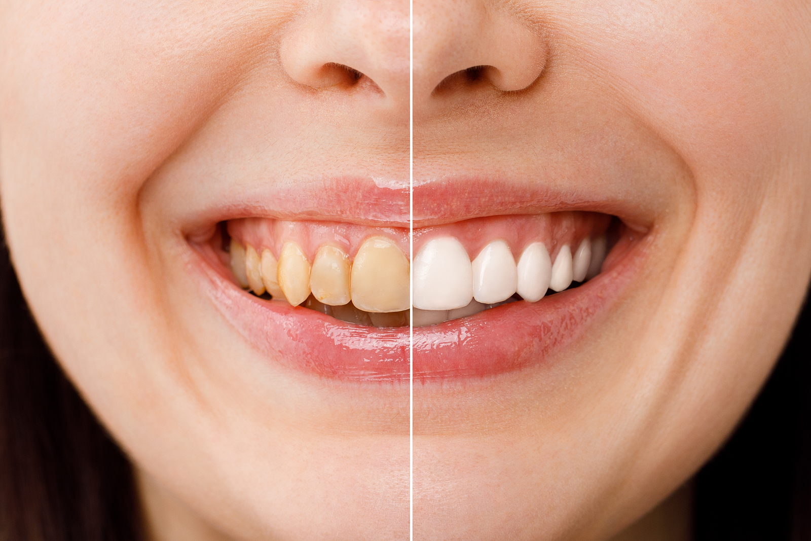 Teeth Whitening Shore Drive Dental Virginia Beach VA