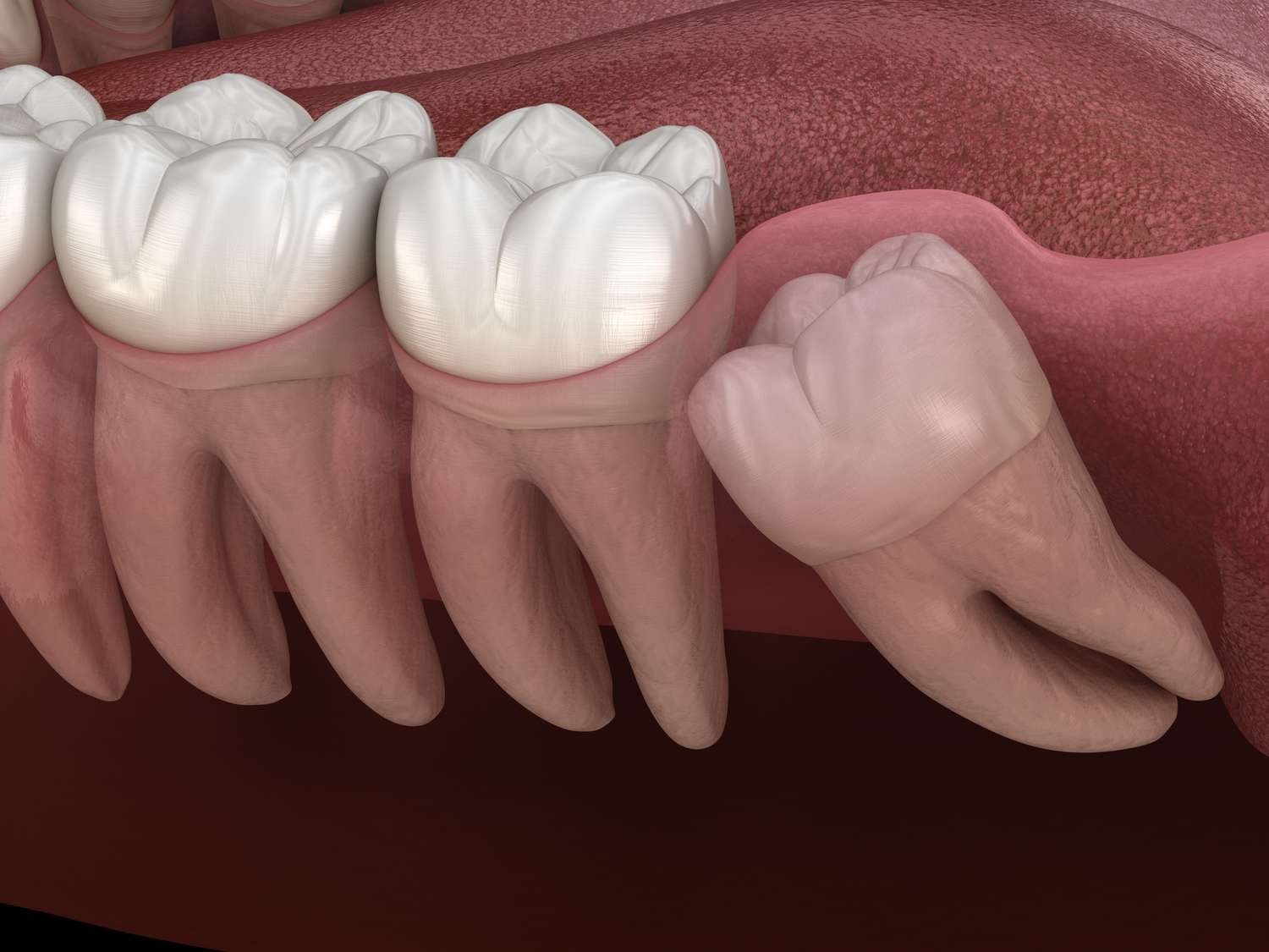 Root Canal Therapy  Carlston Dental Group Los Angeles, Ca