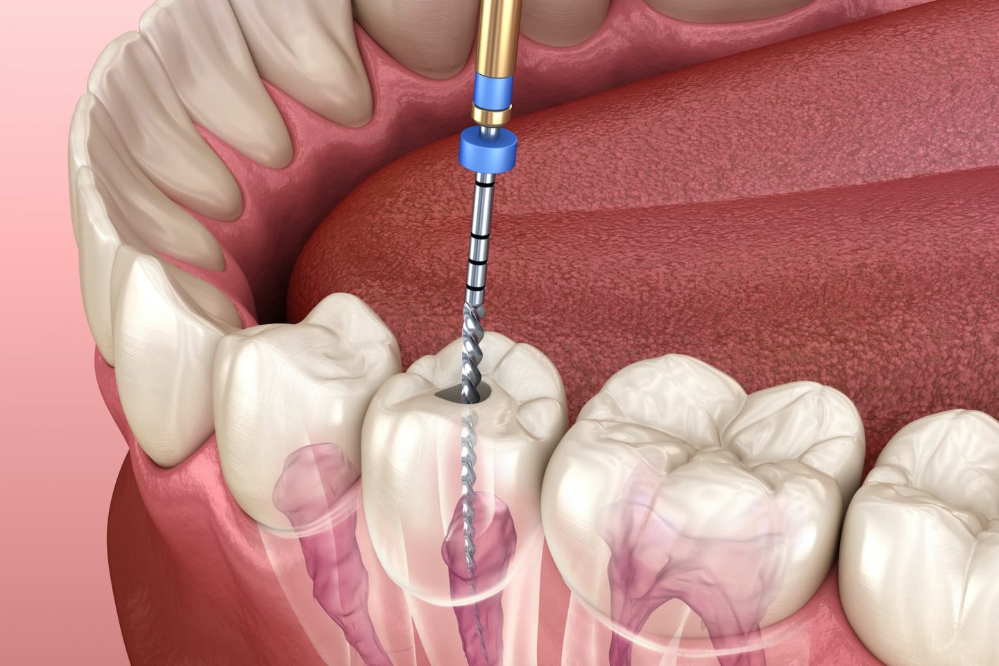 Root Canal Therapy  Carlston Dental Group Los Angeles, Ca