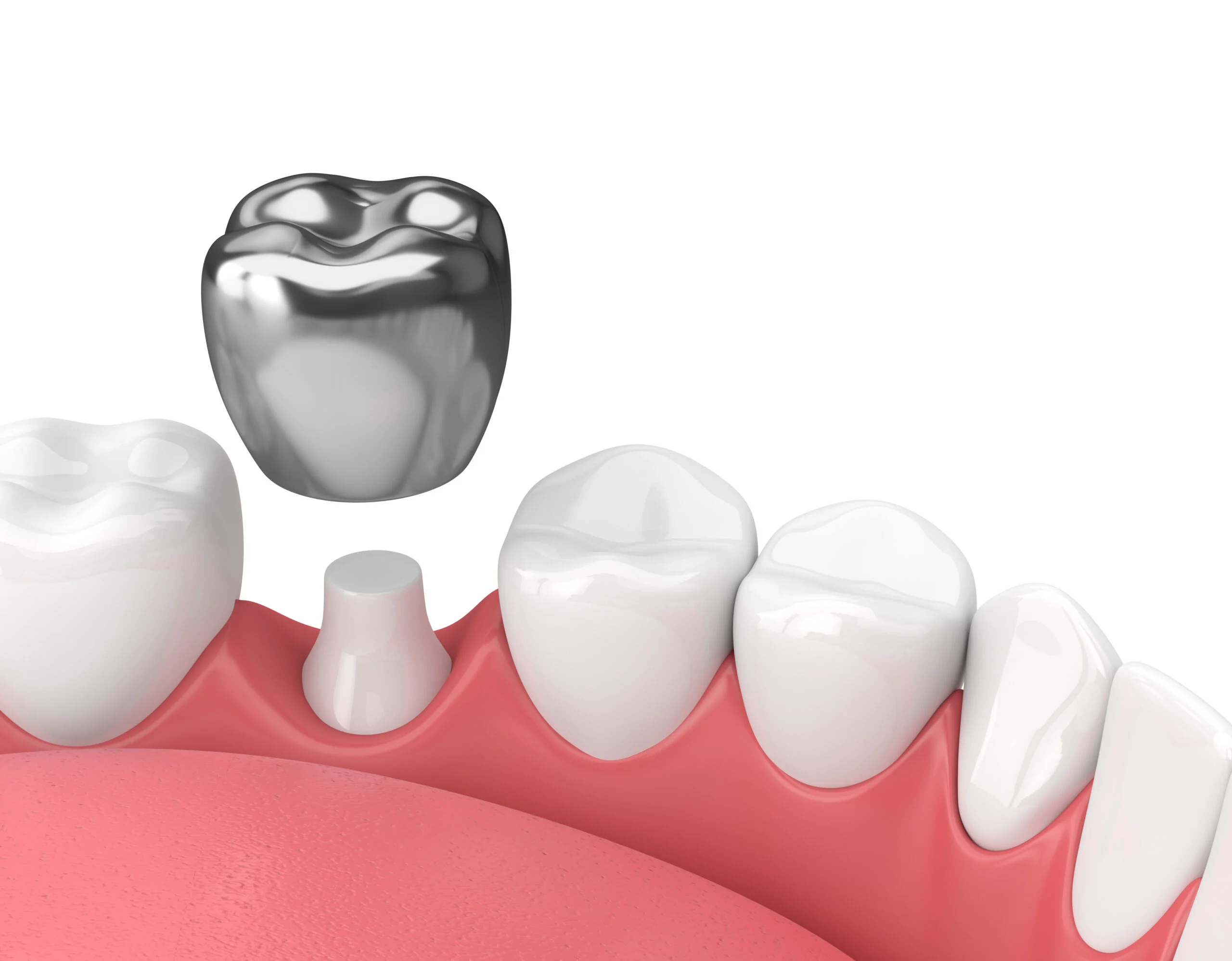 Dental Crowns (Restorative)  Carlston Dental Group Los Angeles, Ca