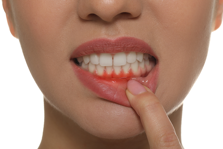 This is a thumbnail image of blog Gum Disease: Causes, Signs & Risks