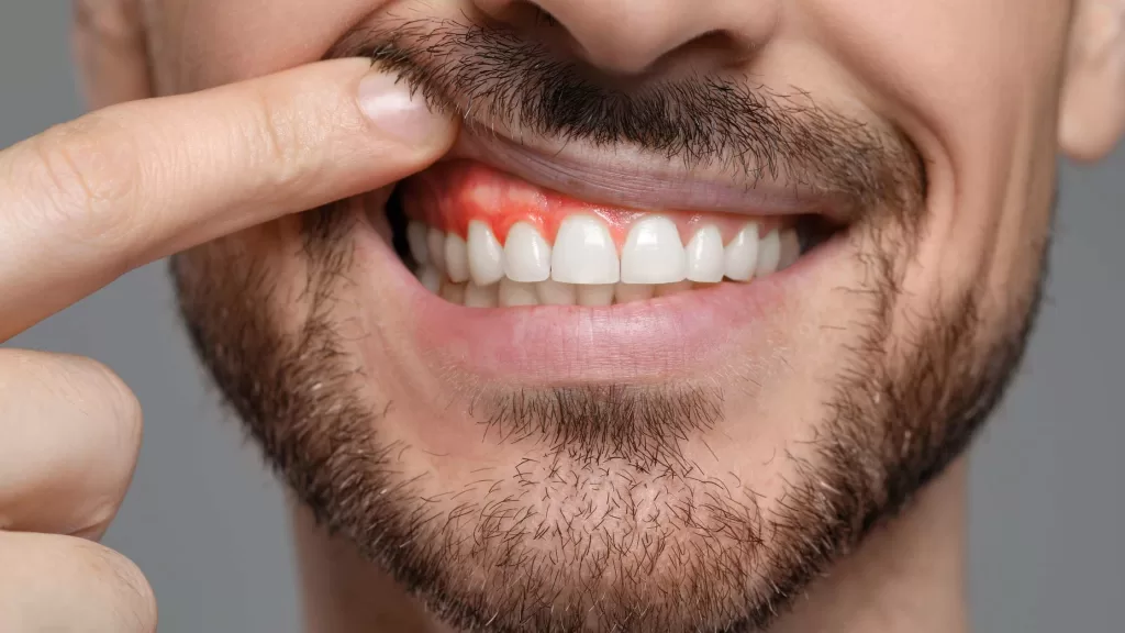 Periodontal Disease Treatment Periodontal Disease Treatment