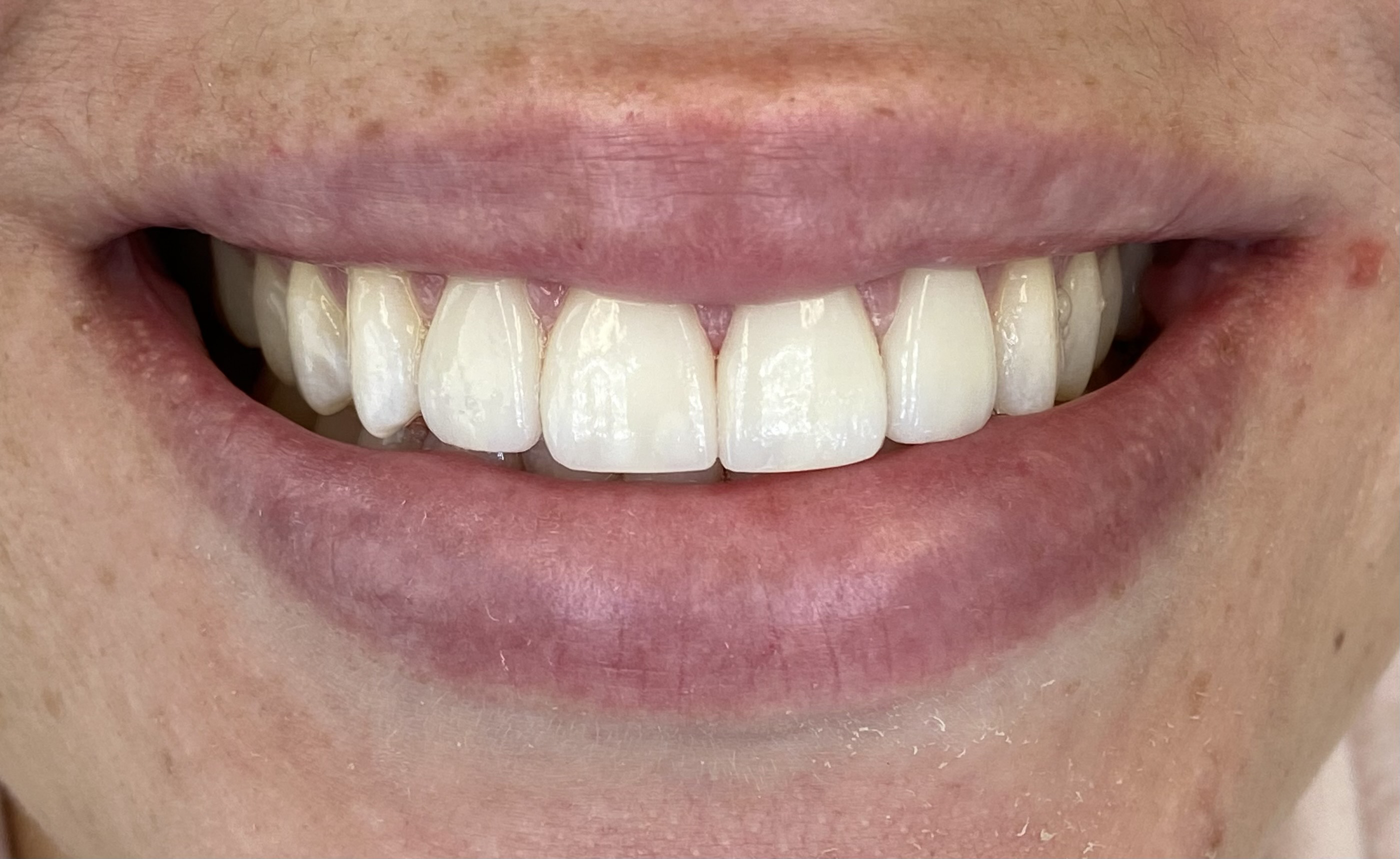 Ceramic-Dental-Veneers-Close2