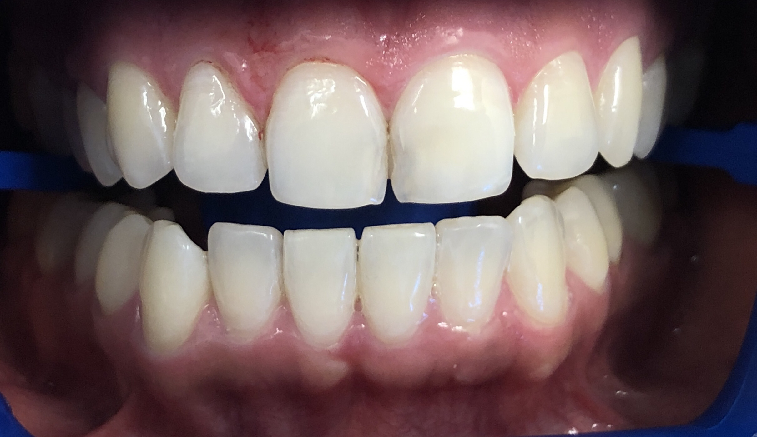 Ceramic-Dental-Veneers-Close6