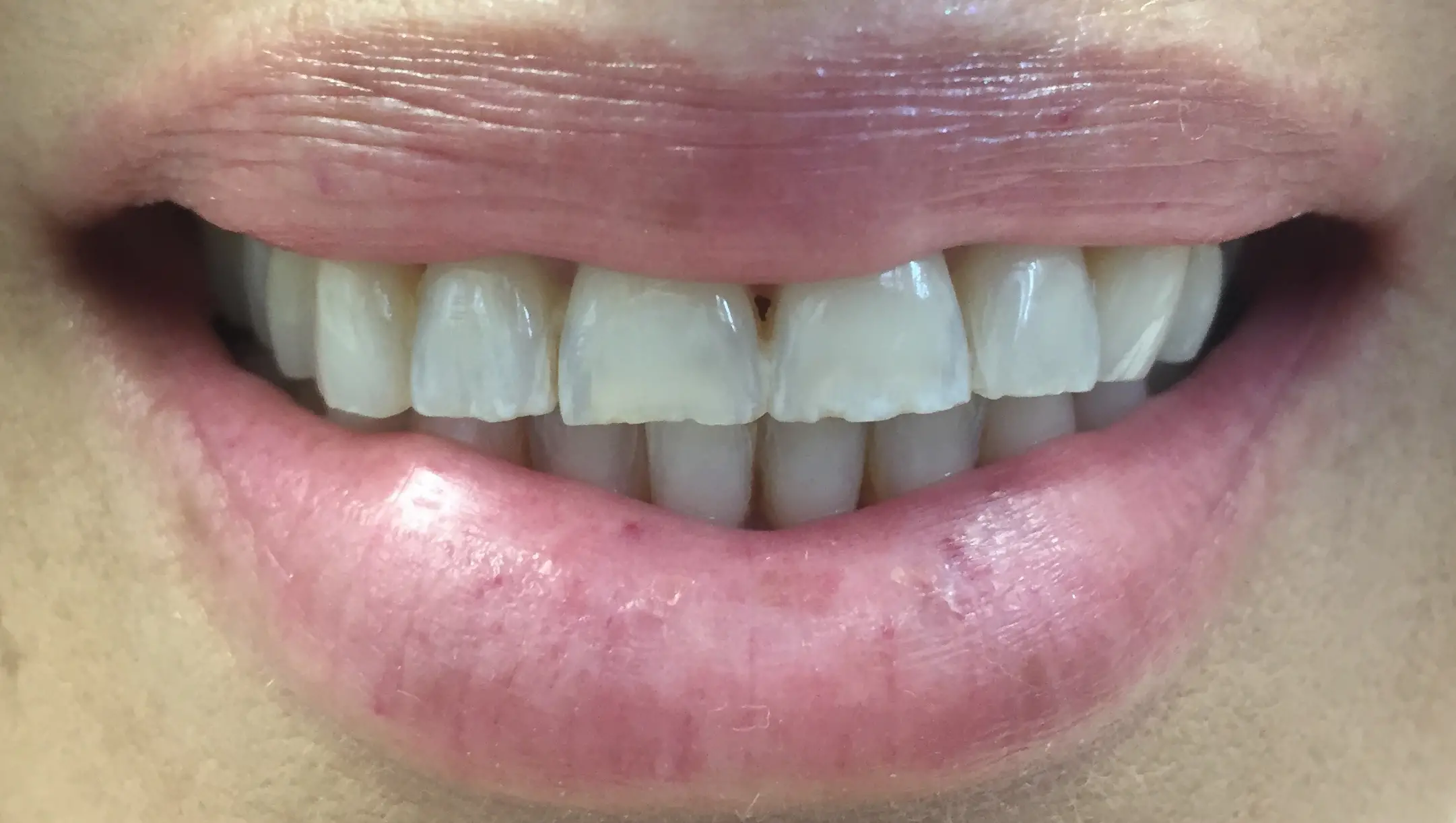 Ceramic-Dental-Veneers-Close3