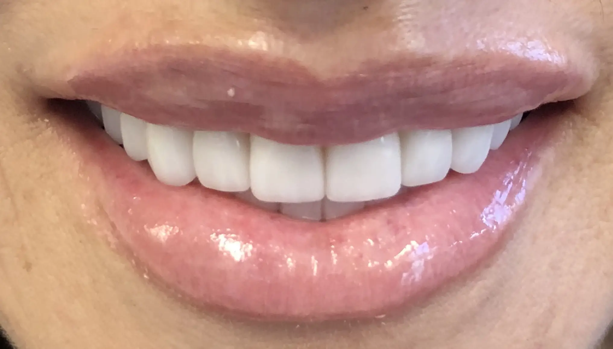 Ceramic-Dental-Veneers-Close4