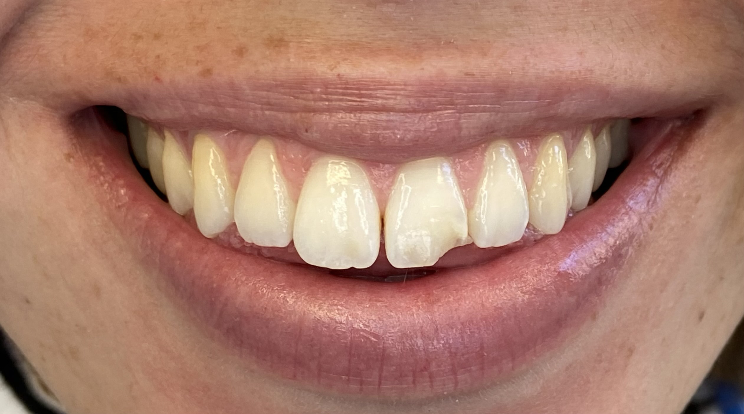 Ceramic-Dental-Veneers-Close