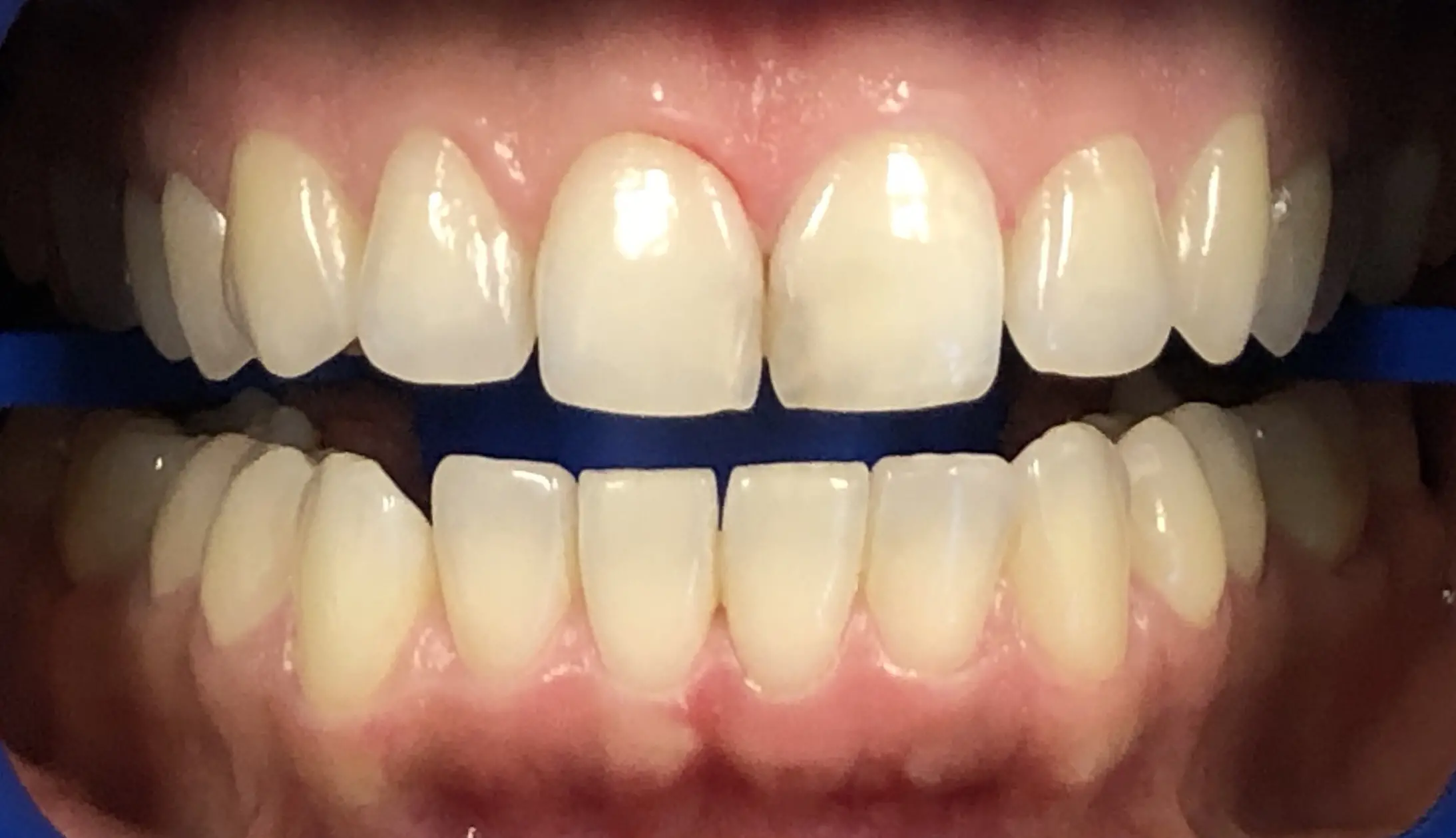 Ceramic-Dental-Veneers-Close5