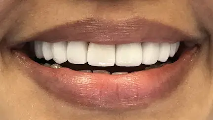 Ceramic-Dental-Veneers-Close8