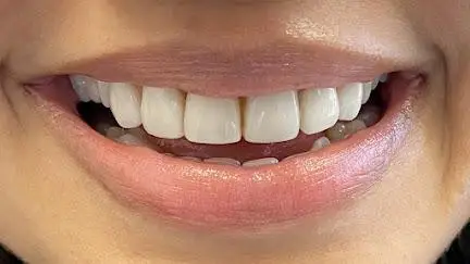 Ceramic-Dental-Veneers-Close7
