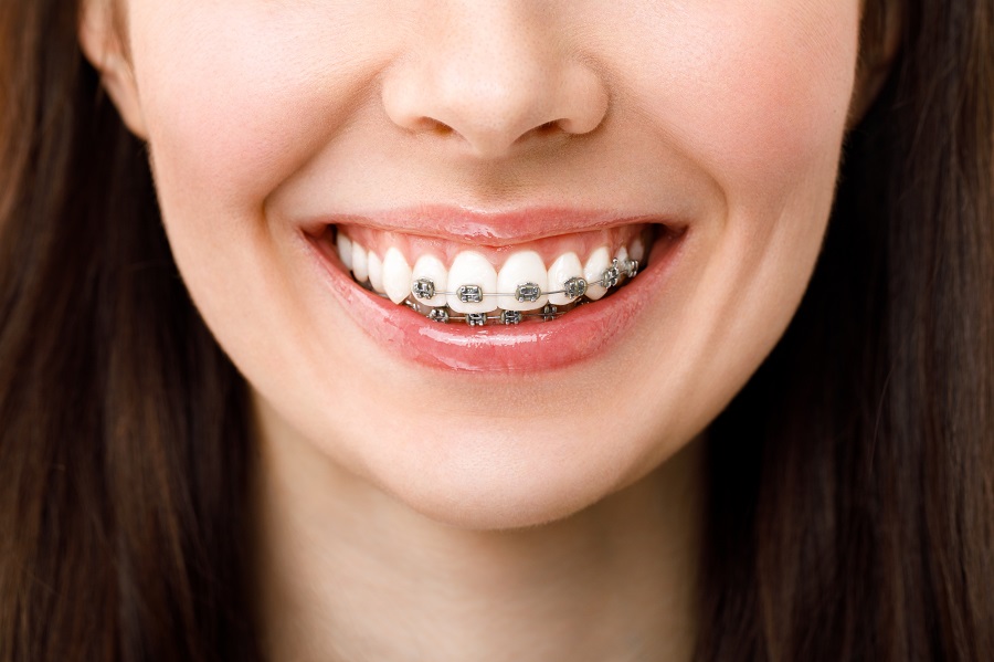 How Do Braces Work? Lawless Orthodontics Bowling Green, KY & Glasgow