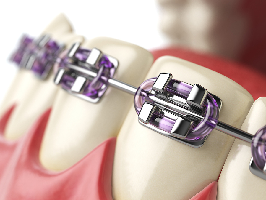 LightForce in Mesa, AZ: Personalized Orthodontic Solutions for a Perfect Smile