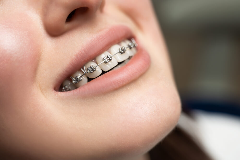 Traditional Braces in Knoxville, TN, Knoxville Orthodontics