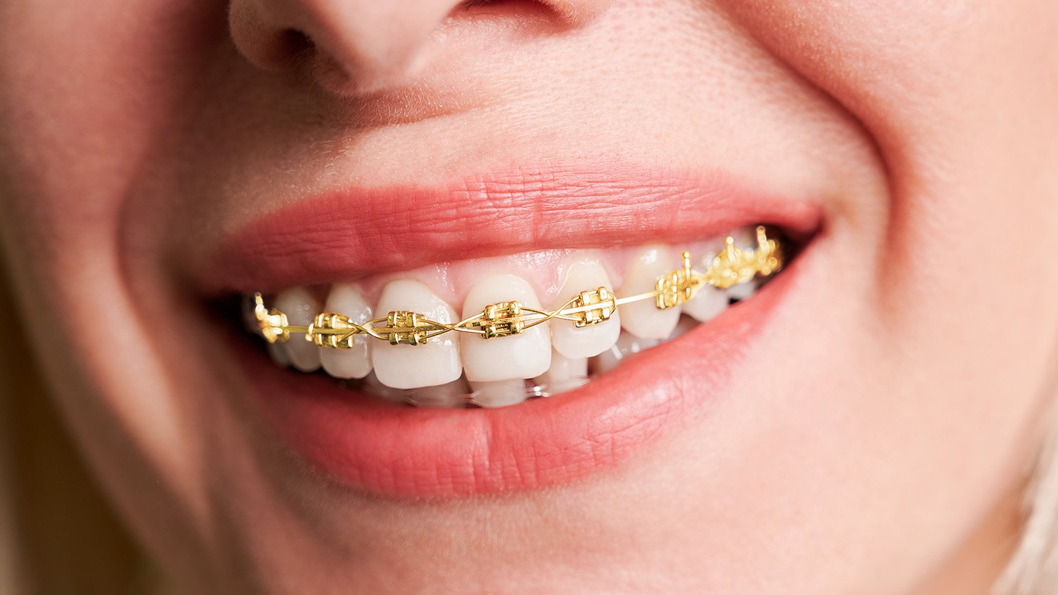 Gold Braces in Knoxville, TN, Knoxville Orthodontics