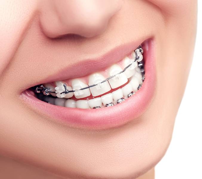 Adult Orthodontics in Knoxville, TN, Knoxville Orthodontics