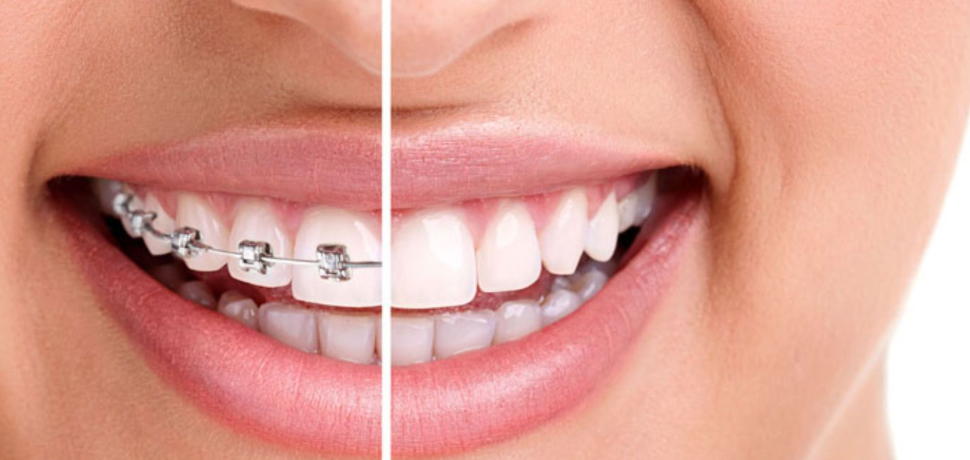 A beautiful smile showing difference between braces & accelerated orthodontics