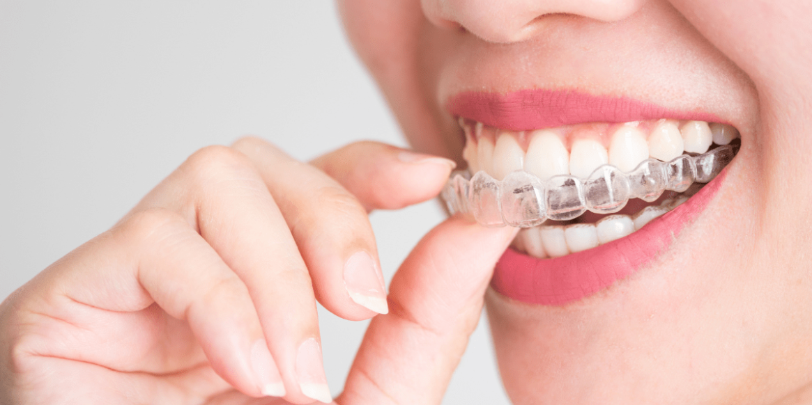 A beautiful woman wearing Invisalign braces A beautiful woman wearing Invisalign braces