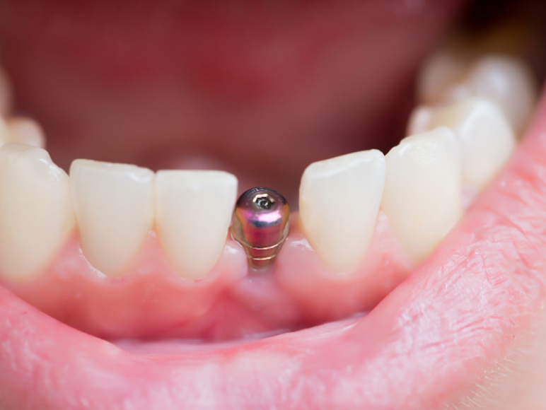 Single Tooth Dental Implant Replacement | Smile Cafe NY