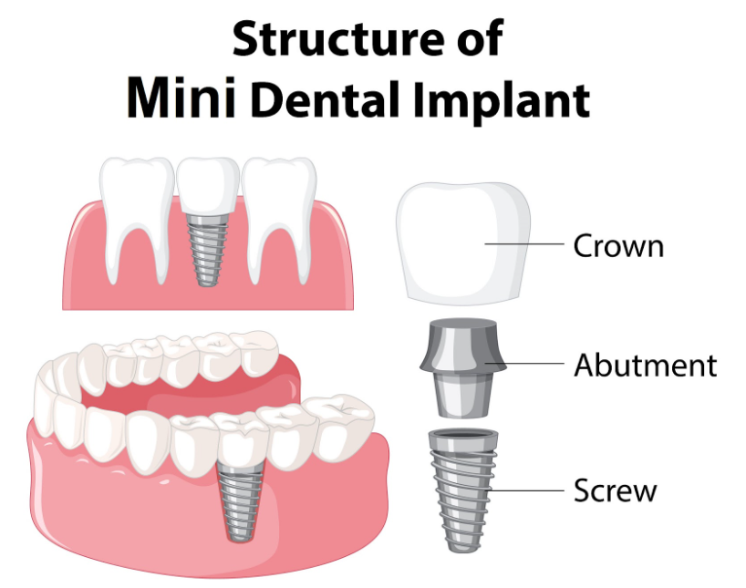 A visual representation of mini dental implants