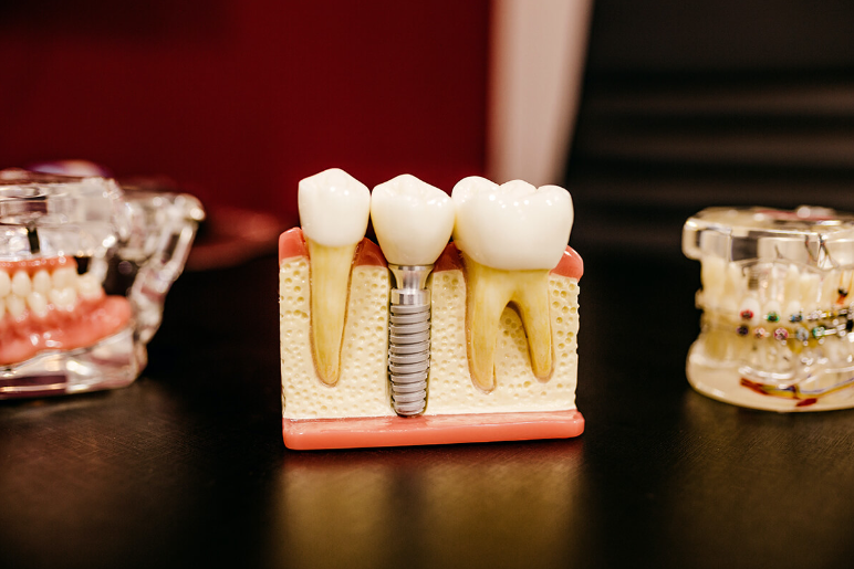 An image showing the dental implant model An image showing the dental implant model