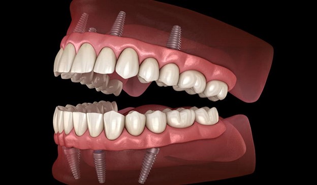 Artificial Jaw Showing How Teeth Implants Work During a Full Mouth
  Dental Implant Cost Consultation   Artificial Jaw Showing How Teeth Implants Work During a Full Mouth
  Dental Implant Cost Consultation
