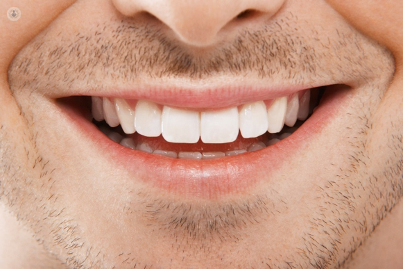 A Man With Beautiful Dental Cosmetic Work Done A Man With Beautiful Dental Cosmetic Work Done