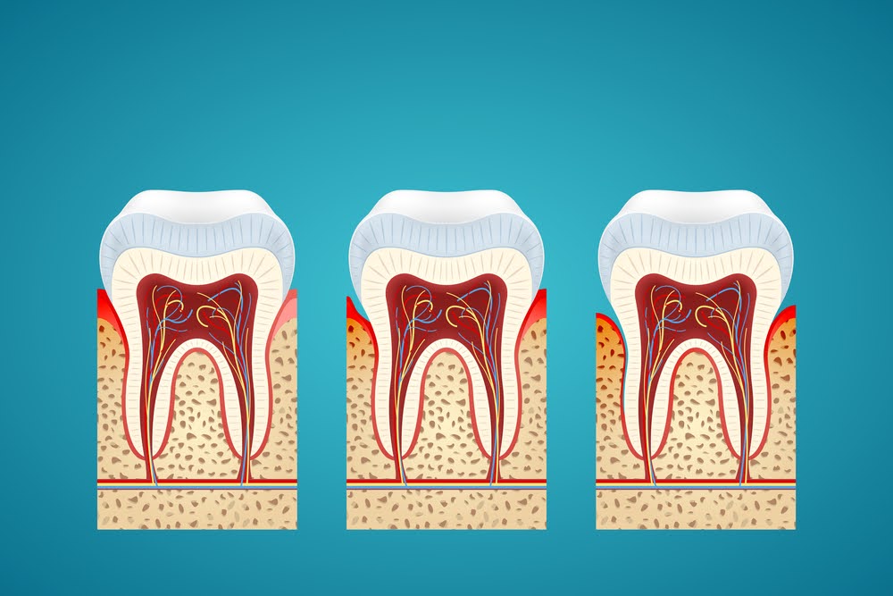 A visual representation of various gum disease stages. A visual representation of various gum disease stages.