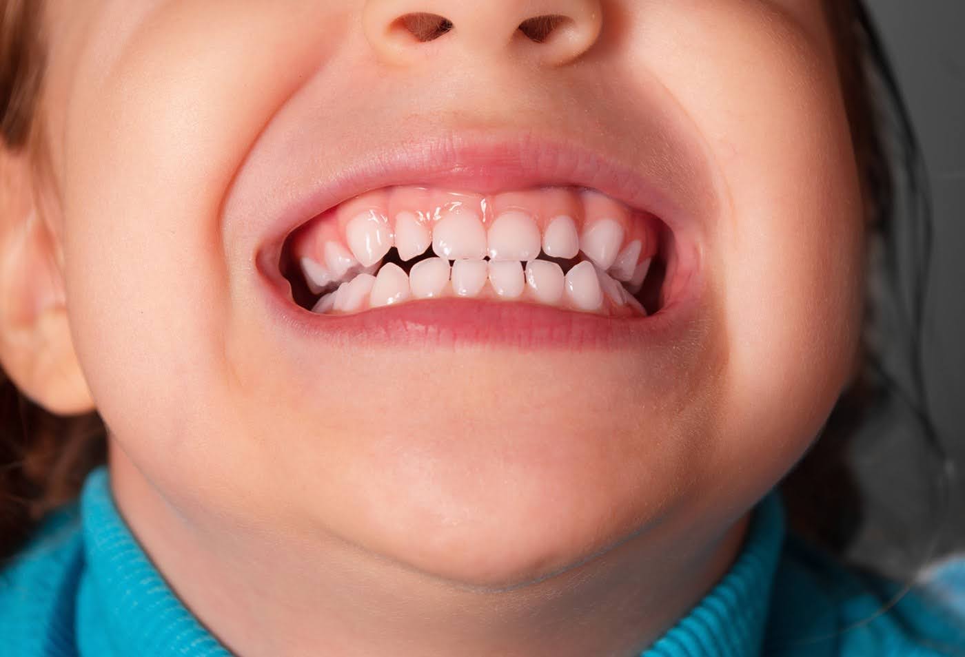 A beautiful, cute girl little girl showing her zirconia dental crowns on her teeth A beautiful, cute girl little girl showing her zirconia dental crowns on her teeth