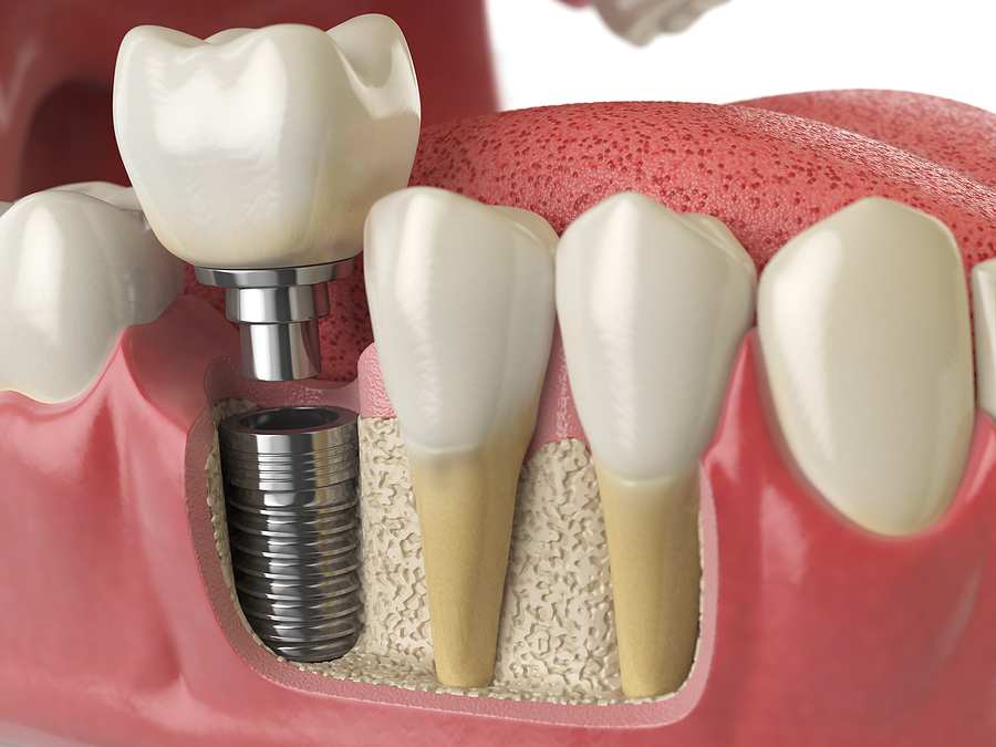 This is a thumbnail image of blog Everything You Need to Know About Dental Implants: A Permanent Solution for Missing Teeth