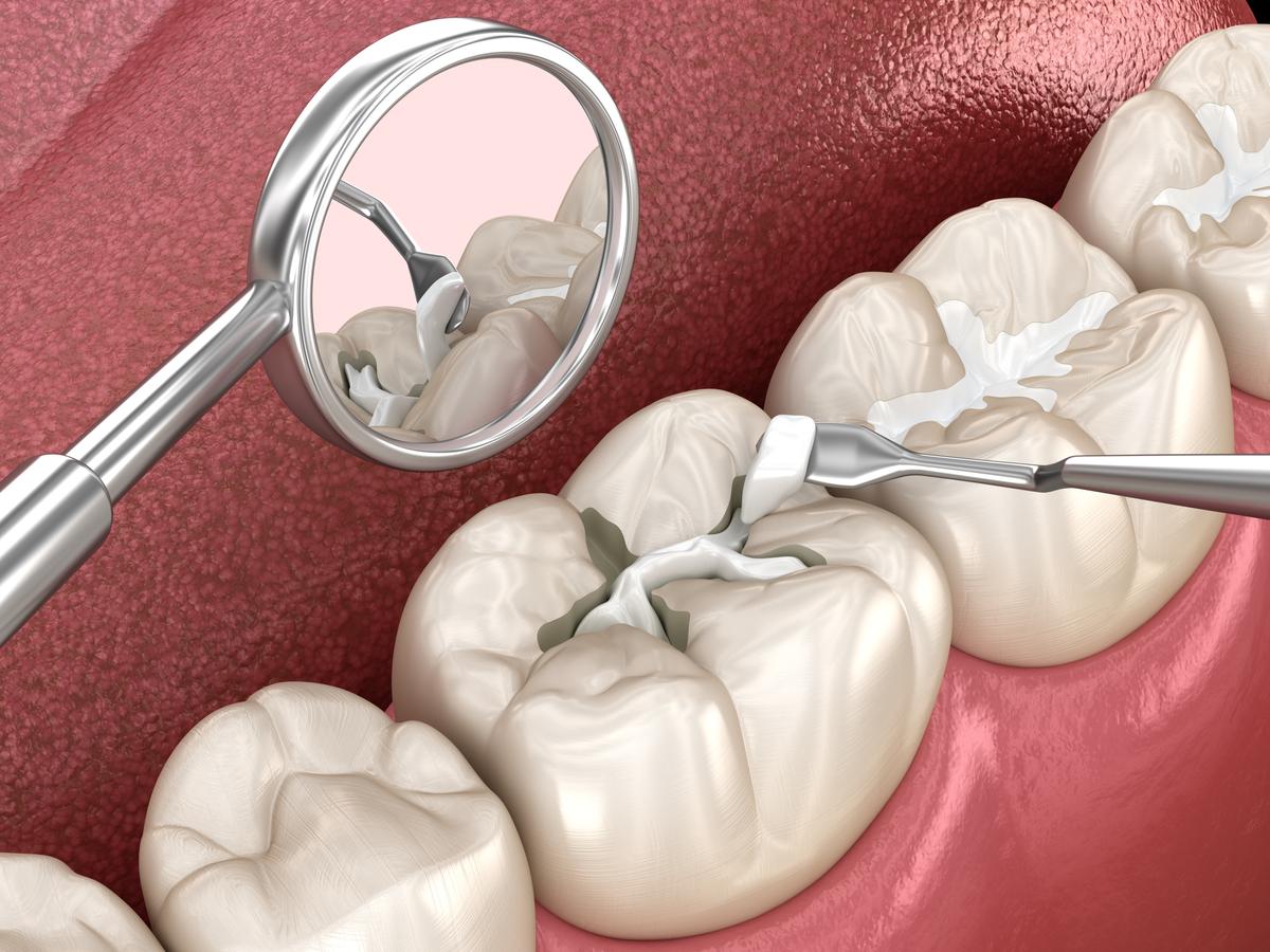 Composite Fillings  Rockwall Dental Associates