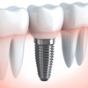 Dental Implants Dental Implants