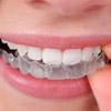 Invisalign Invisalign