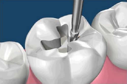 Tooth Colored Fillings Tooth Colored Fillings