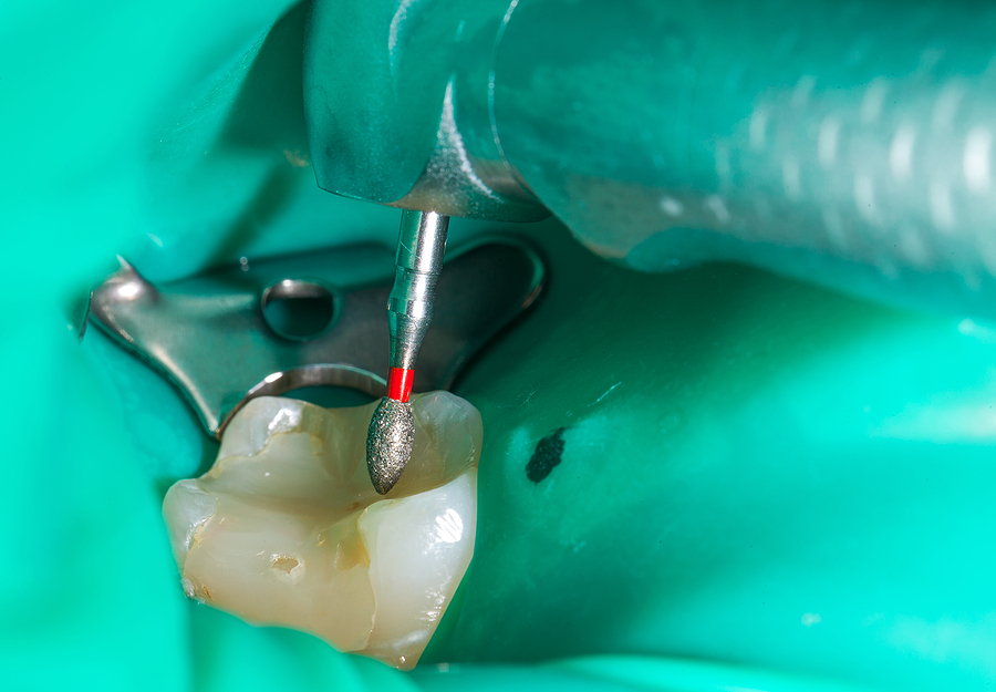 This is a thumbnail image of blog Comprehensive Care for Your Smile: Endodontics in Tyler, TX