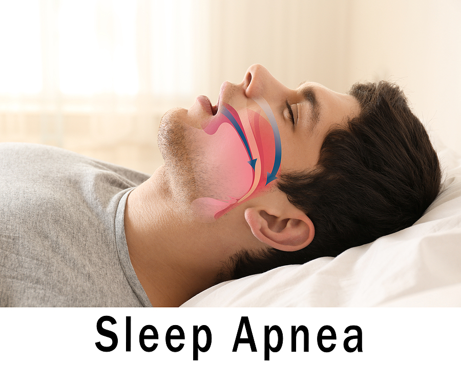 This is a thumbnail image of blog Sleep Apnea: Causes, Symptoms, and Effective Treatment Options in Tyler, TX