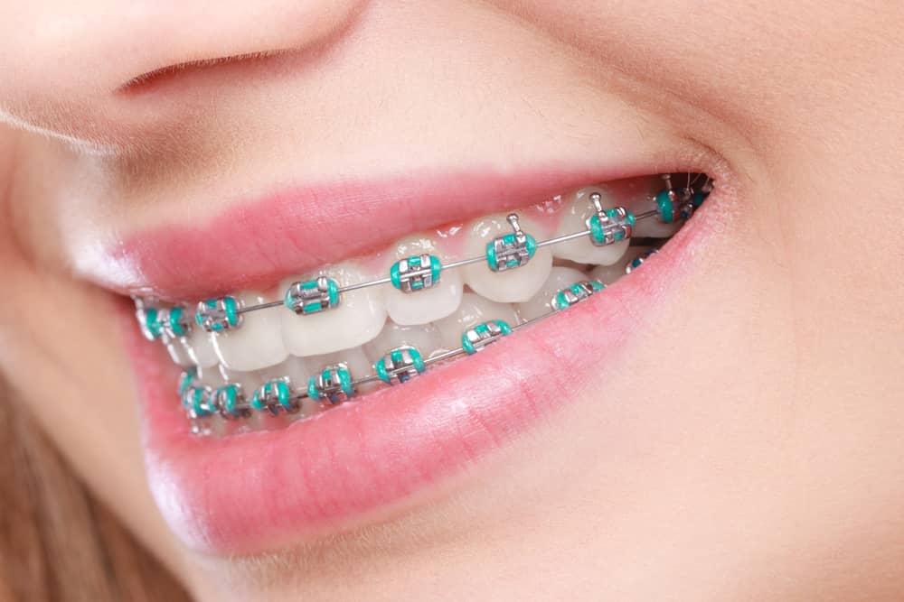 Braces in Sacramento, Rocklin, Roseville, CA