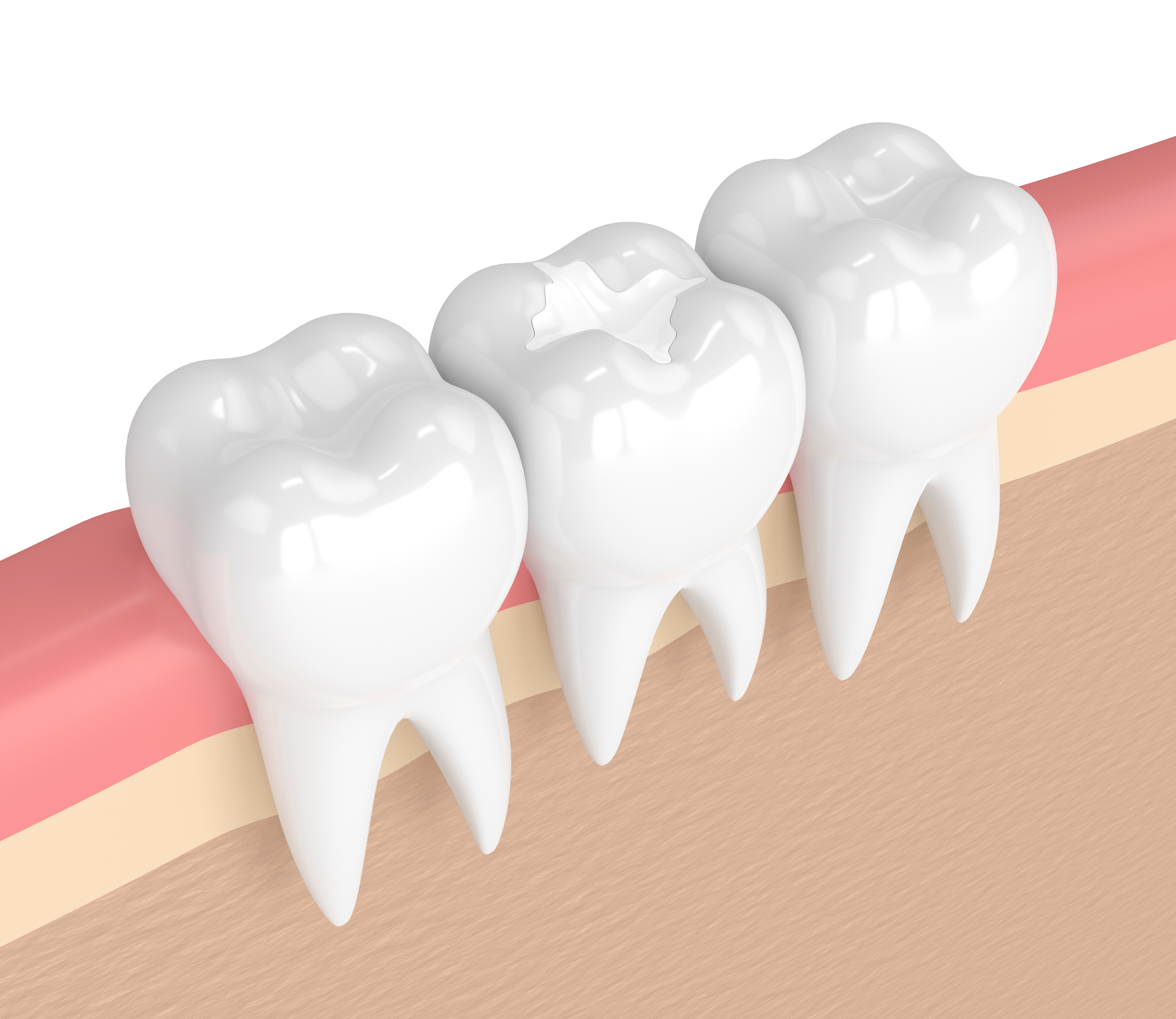 Types of Tooth Fillings - Dental Tips