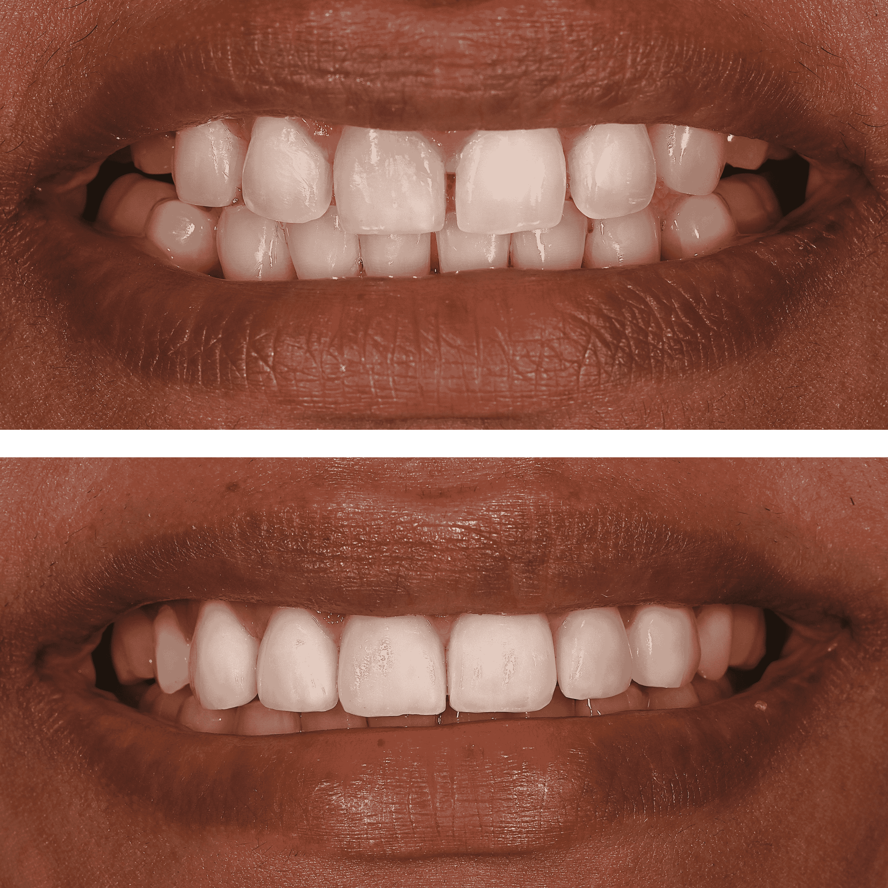 Veneers Before And After Gaps
