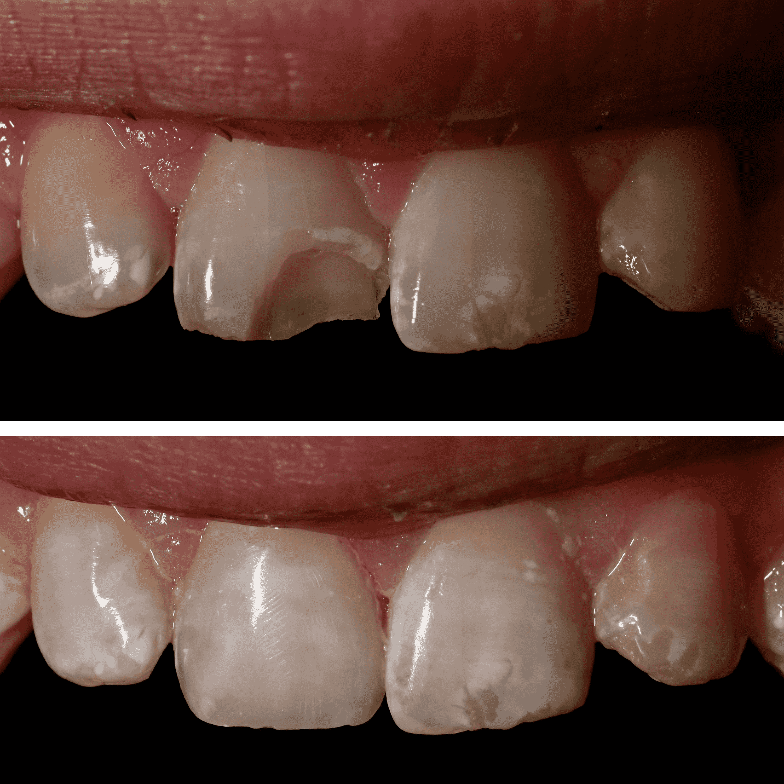 Before and Afters | Essence of Dentistry PLLC Redmond, WA