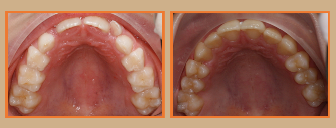 Before And After Rafati Orthodontics San Jose Ca