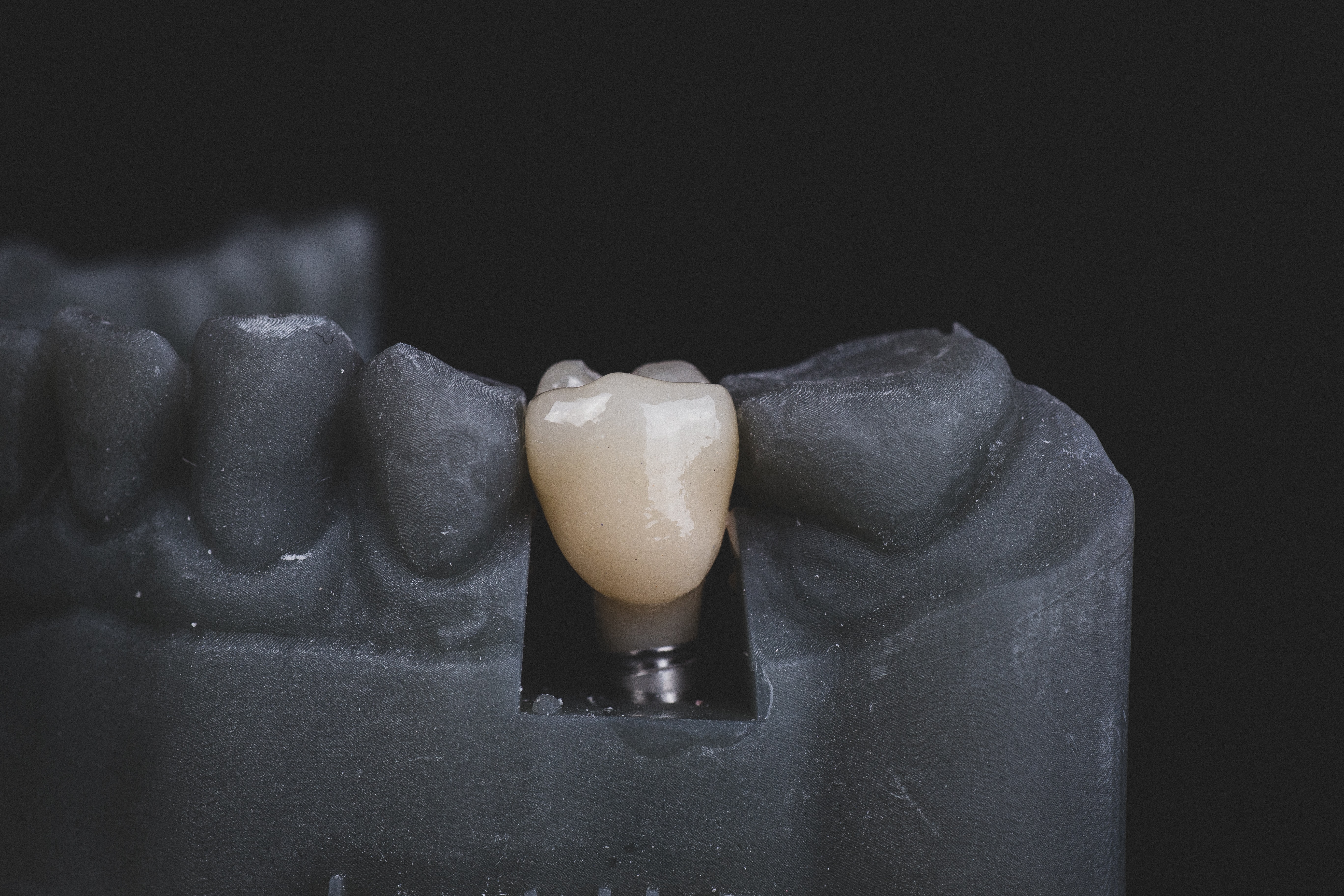 This is a thumbnail image of blog The Ultimate Guide to Dental Implants: Why They’re the Gold Standard for Tooth Replacement