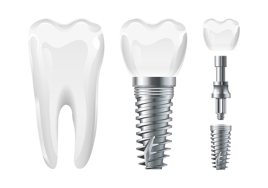 This is a thumbnail image of blog Understanding Dental Implant Abutments: A Key Component of a Lasting Smile