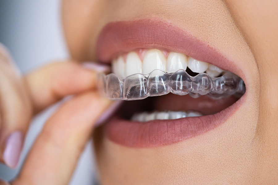 This is a thumbnail image of blog Transform Your Smile with Clear Aligners in Alton, Donna, and McAllen, TX