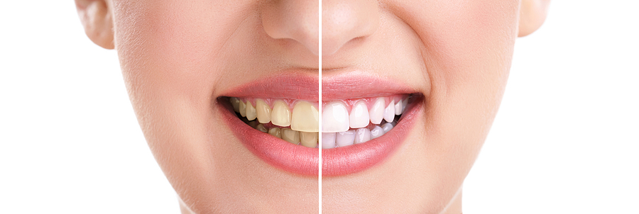 This is a thumbnail image of blog Achieve a Brighter Smile with Professional Teeth Whitening