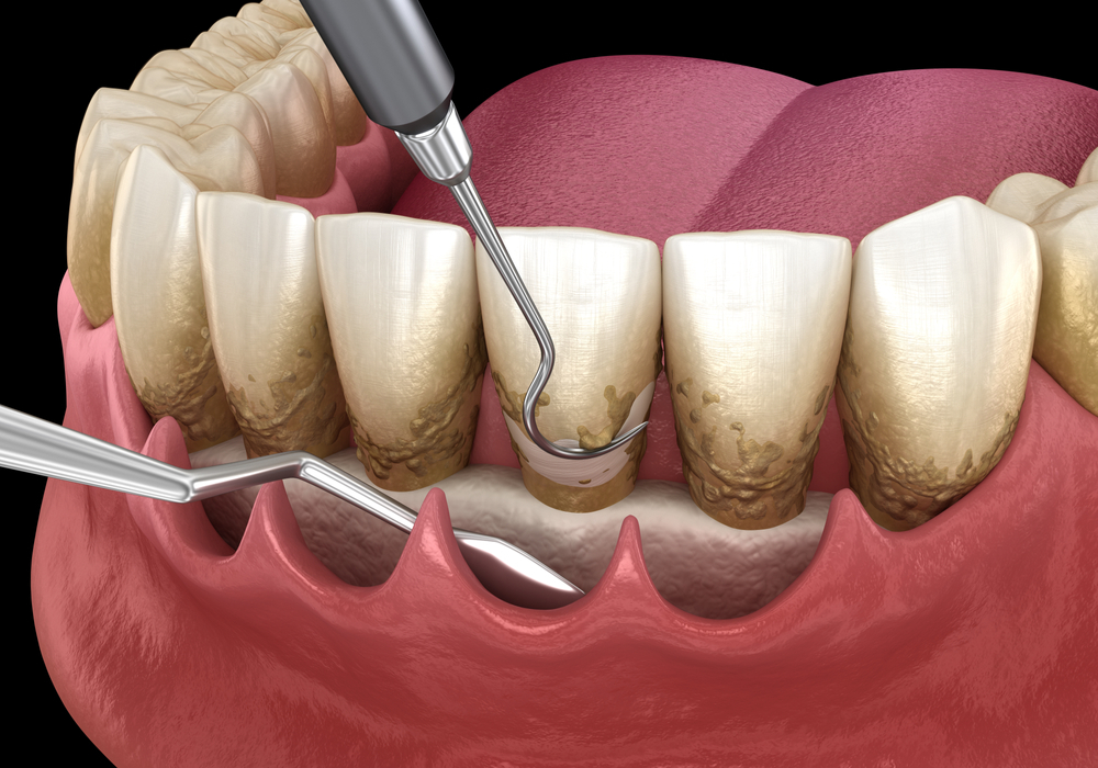 Root Planing Curettage Summerland Dental Summerland Key FL