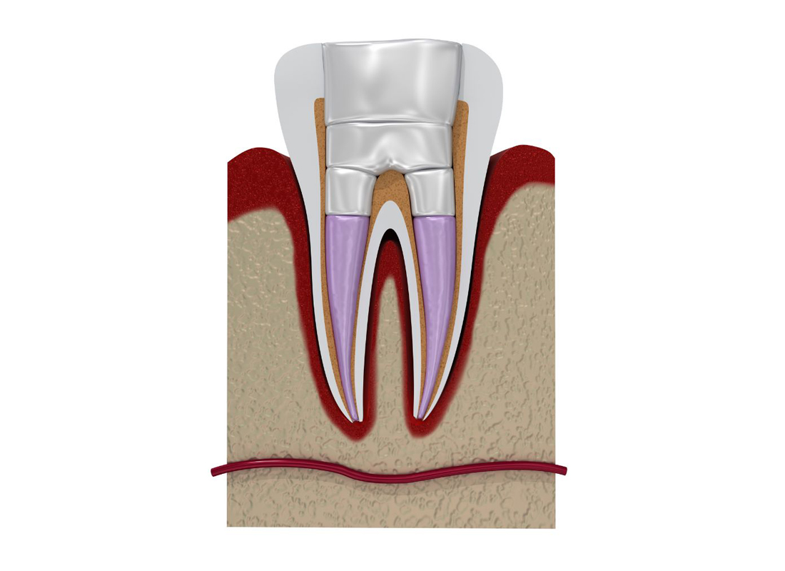 Fiber-reinforced restoration of a structurally compromised tooth