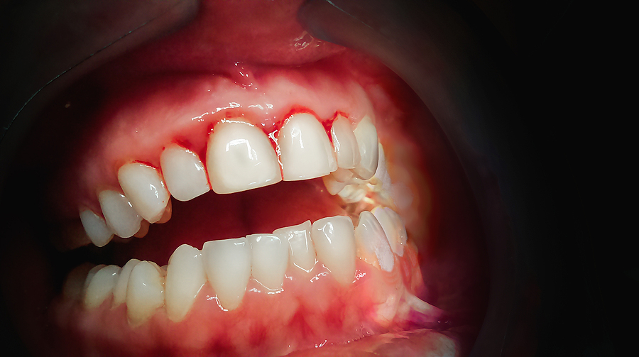 This is a thumbnail image of blog Comprehensive Care for Healthy Gums: Gum Treatment in Fort Collins, CO