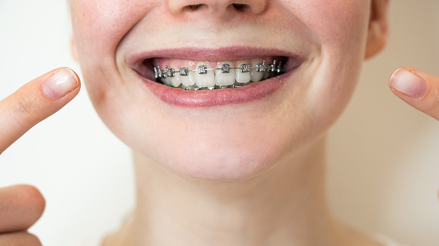 This is a thumbnail image of blog Achieve a Perfect Smile with Traditional Braces in The Woodlands, TX