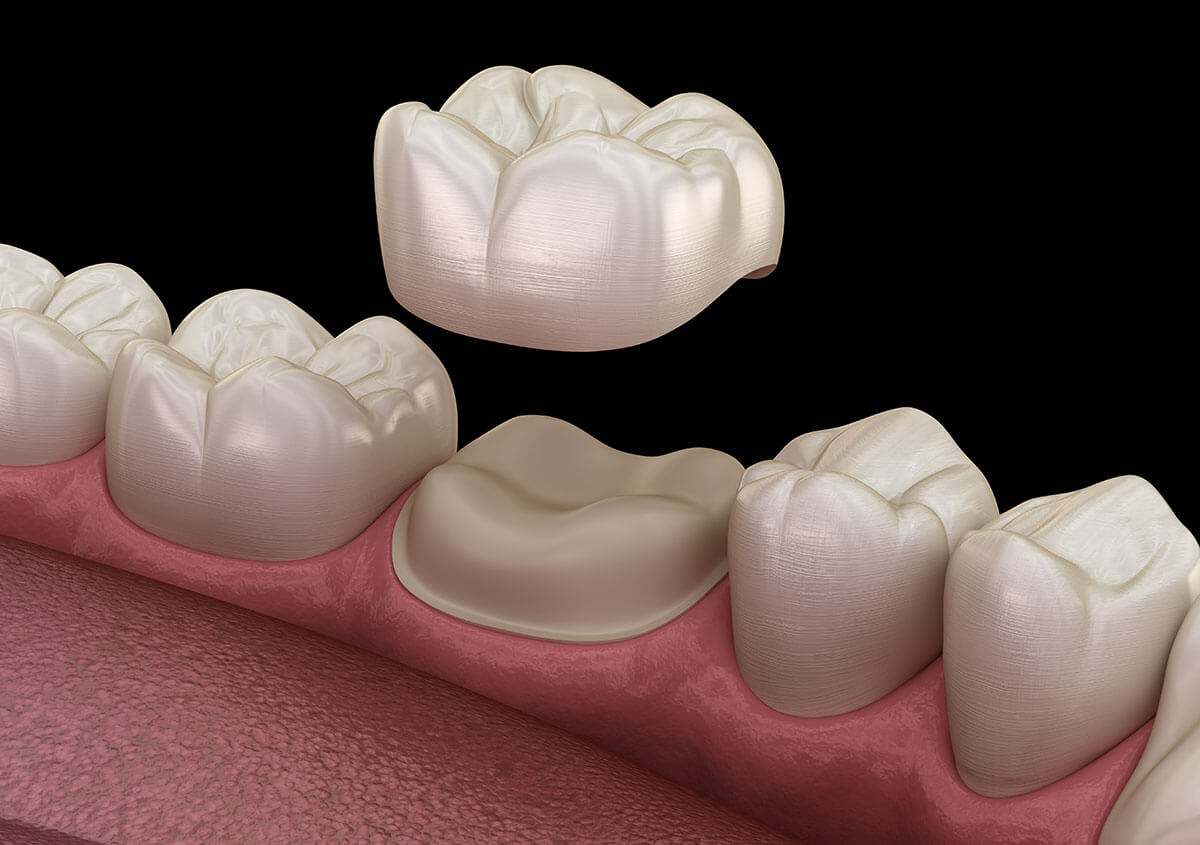 This is a thumbnail image of blog Damaged Tooth? Restore Its Function and Beauty with a Porcelain Crown This is a thumbnail image of blog Damaged Tooth? Restore Its Function and Beauty with a Porcelain Crown