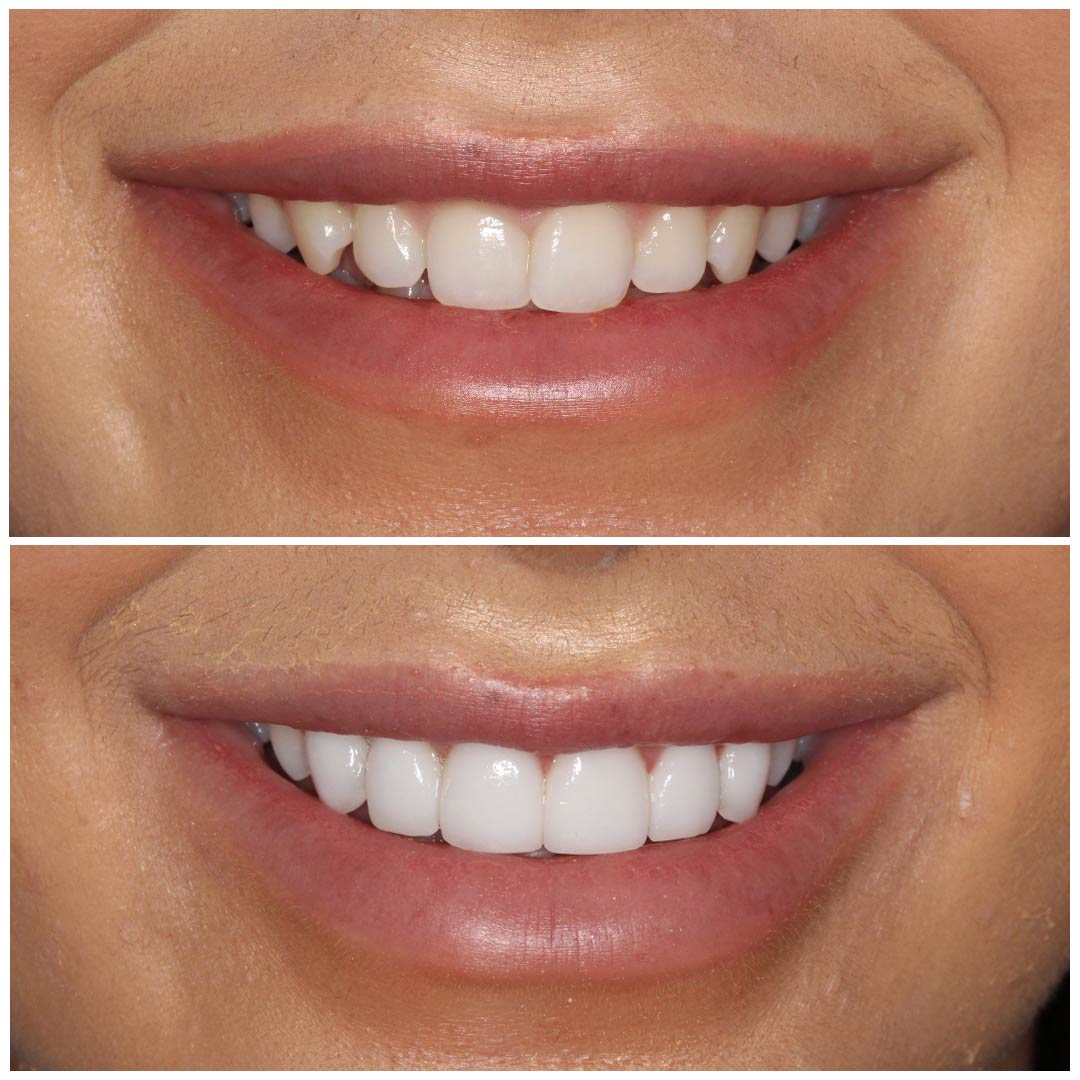 smiling-dental-porcelain-veneers-before-after smiling-dental-porcelain-veneers-before-after